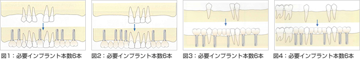 図1：必要インプラント本数6本　図2：必要インプラント本数6本　図3：必要インプラント本数6本　図4：必要インプラント本数6本