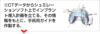 ②CTデータからシュミレーションソフト上でインプラント埋入計画を立てる。その情報をもとに、手術用ガイドを作製する。