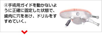 ④手術用ガイドを動かないように正確に固定した状態で、歯肉に穴をあけ、ドリルをすすめていく。