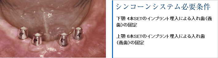 シンコーンシステム必要条件　下顎4本SETのインプラント埋込による入れ歯（義歯）の固定　上顎6本SETのインプラント埋込による入れ歯（義歯）の固定