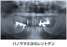 パノラマ2次元レントゲン