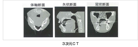 3次元CT