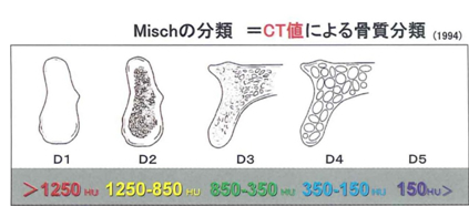 Mischの分類＝CT値による骨質分類（1994）
