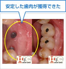 安定した歯肉ができた