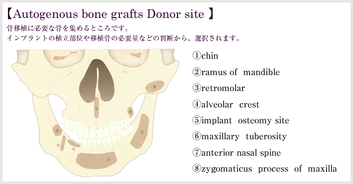 骨移植に必要な骨を集めるところです。インプラントの植立部位や移植骨の必要量などの判断から、選択されます。