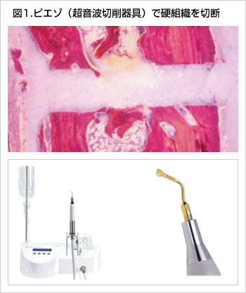 図1.ピエゾ（超音波切削器具）で硬組織を切断