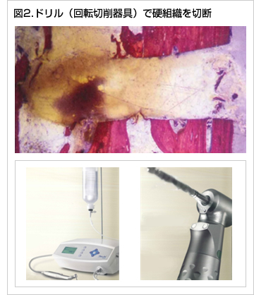 図2.ドリル（回転切削器具）で硬組織を切断