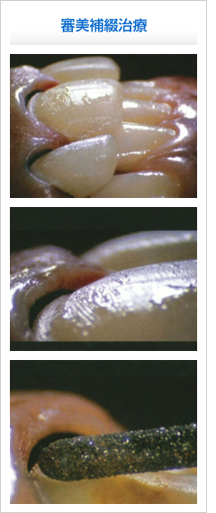 審美補綴治療