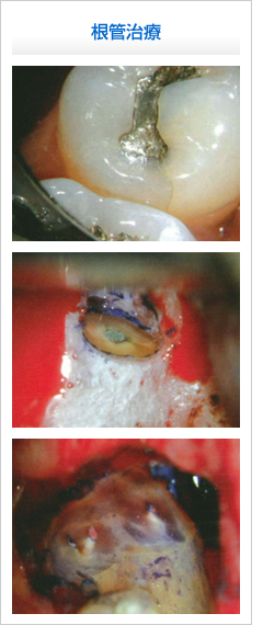 根管治療