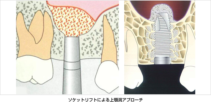 ソケットリフトによる上顎洞アプローチ