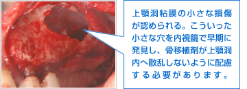 上顎洞粘膜の小さな損傷が認められる。こういった小さな穴を内視鏡で早期に発見し、骨移植剤が上顎洞内へ散乱しないように配慮する必要があります。