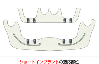 ショートインプラントの適応部位