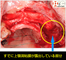 すでに上顎洞粘膜が露出している部分