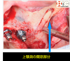 上顎洞の開窓部分