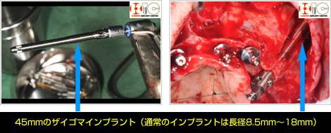 45mmのザイゴマインプラント（通常のインプラントは長径8.5mm～18mm）