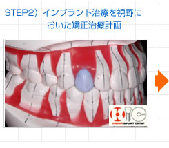 STEP2）インプラント治療を視野においた矯正治療計画