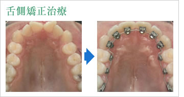 舌側矯正治療