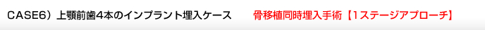 CASE6）上顎前歯4本のインプラント埋入ケース 骨移植同時埋入手術【1ステージアプローチ】