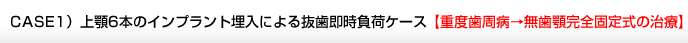 CASE1）上顎6本のインプラント埋入による抜歯即時負荷ケース 【重度歯周病→無歯顎完全固定式の治療】