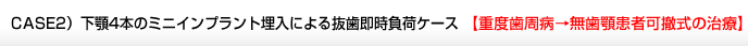 CASE2）下顎4本のミニインプラント埋入による抜歯即時負荷ケース 【重度歯周病→無歯顎患者可撤式の治療】