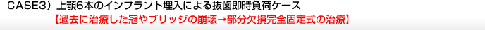 CASE3）上顎6本のインプラント埋入による抜歯即時負荷ケース【過去に治療した冠やブリッジの崩壊→部分欠損完全固定式の治療】 