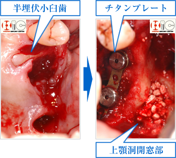 半埋伏小臼歯　チタンプレート　上顎洞開窓部