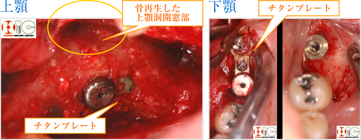 上顎 骨再生した上顎洞開窓部　下顎　チタンプレート