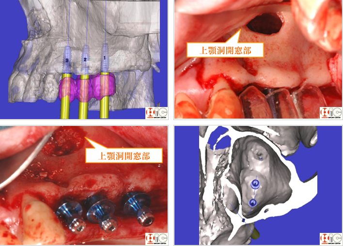 半埋伏小臼歯　チタンプレート　上顎洞開窓部