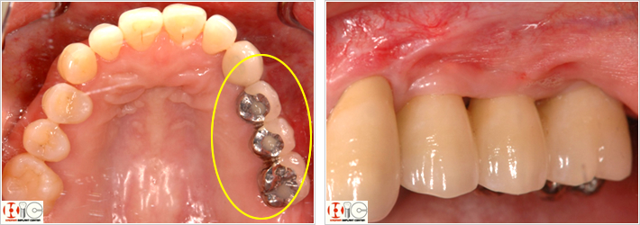 半埋伏小臼歯　チタンプレート　上顎洞開窓部
