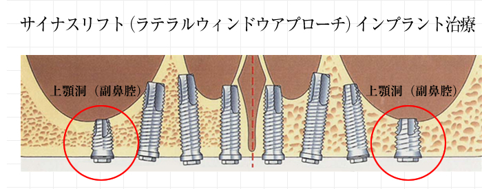 サイナスリフト（ラテラルウィンドウアプローチ）インプラント治療