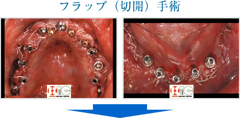 フラップ(切開手術)