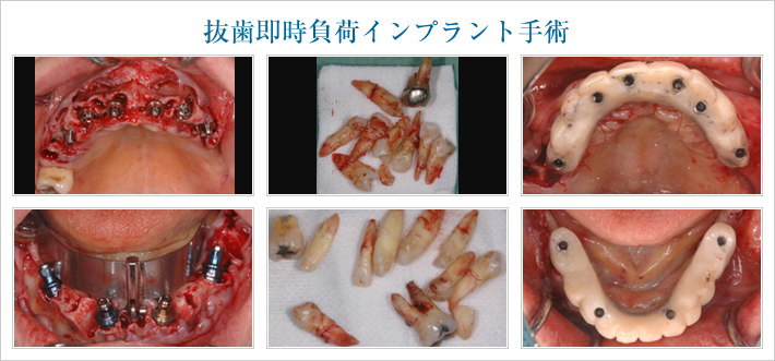 抜歯即時負荷インプラント手術