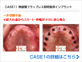 CASE2）無歯顎フラップ即時負荷インプラント