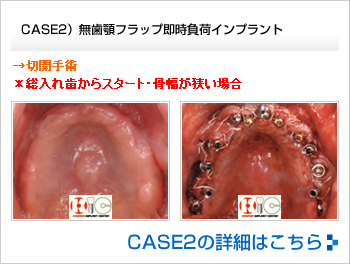 CASE2）無歯顎フラップ即時負荷インプラント