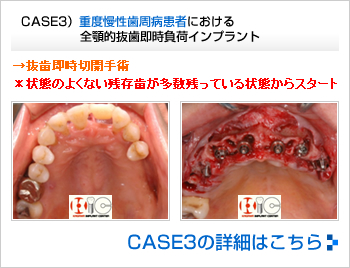 CASE2）無歯顎フラップ即時負荷インプラント