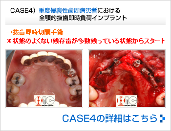 CASE2）無歯顎フラップ即時負荷インプラント
